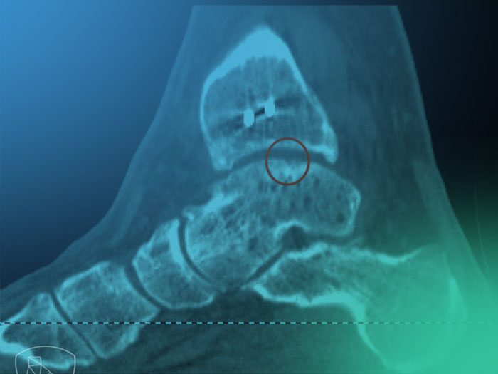 Refresca tus conocimientos sobre la osteocondritis del astrágalo y su clasificación