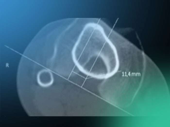 Descubre la utilidad de TAC en los diagnósticos de rodilla