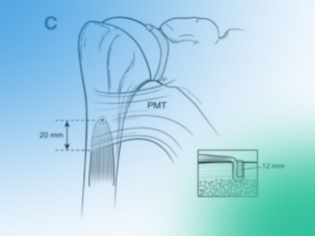 Tenodesis de la Porción larga del bíceps (PLB) en el hombro doloroso
