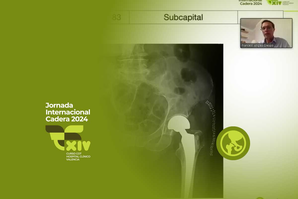 Revolución en el Tratamiento de Fracturas de Cuello Femoral: Reconstrucción vs. Sustitución Según el Dr. Frances Angles Crespo